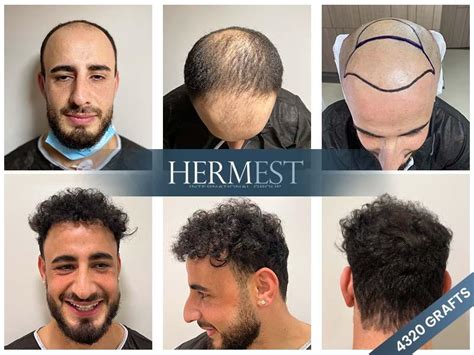 hermes hair transplant clinic istanbul turkey|hermest hair clinic turkey.